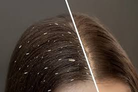 Best Natural Treatment for Head Lice & Nits